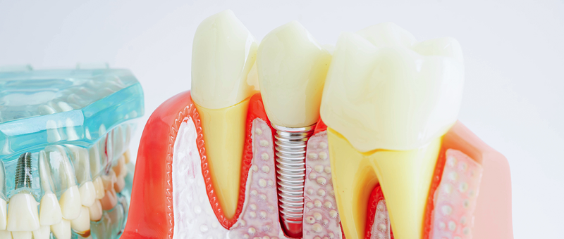 Implantat